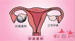 广州哪要捐卵，广州试管婴儿捐卵供卵条件